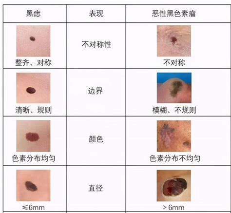 身体痣|痣（黑素细胞痣）